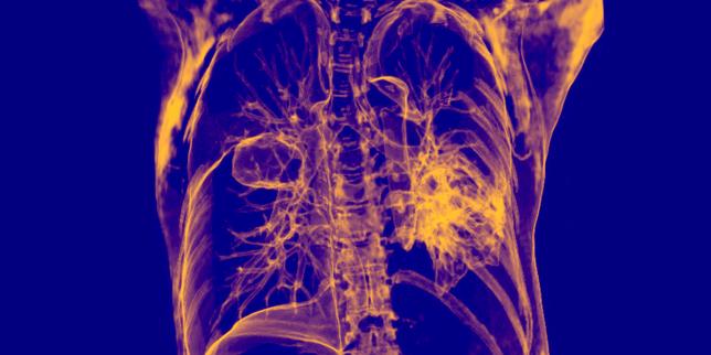 Cancers du poumon à petites cellules : une nouvelle immunothérapie permet un gain de survie « jamais vu »